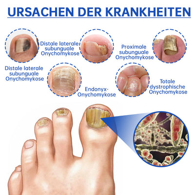 PureNail™ | Lasertherapiegerät gegen Nagelpilz