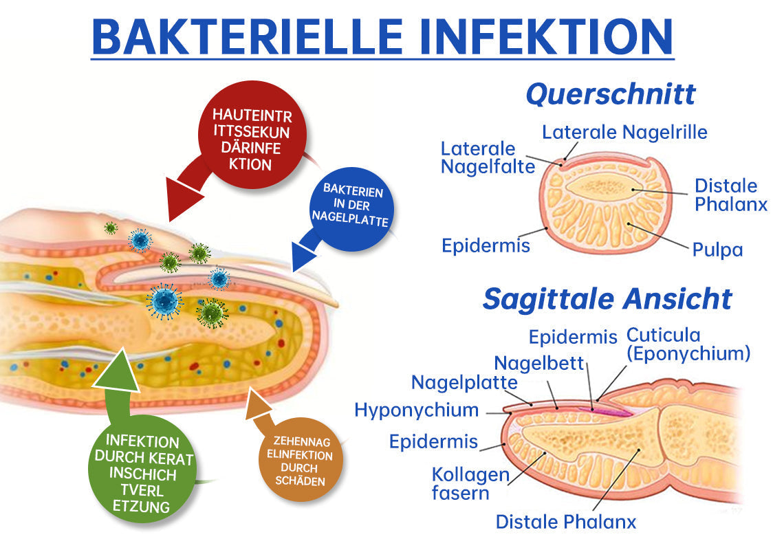 PureNail™ | Lasertherapiegerät gegen Nagelpilz