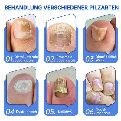 PureNail™ | Lasertherapiegerät gegen Nagelpilz